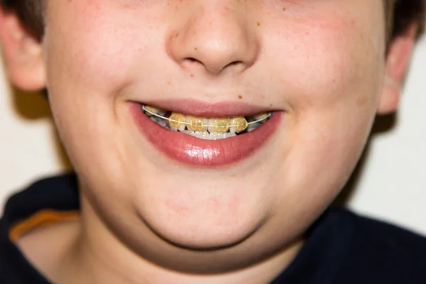 Frenos y dientes blancos del niño sonriente — Foto de Stock