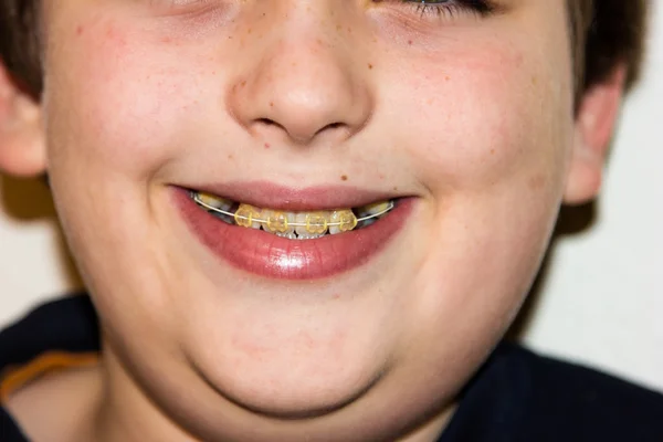 Frenos y dientes blancos del niño sonriente — Foto de Stock