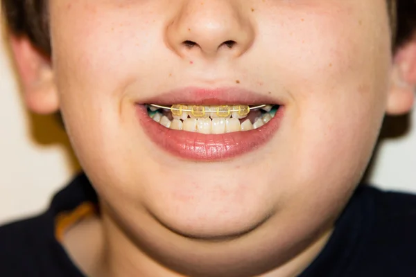 Hängslen och vita tänder leende pojke — Stockfoto