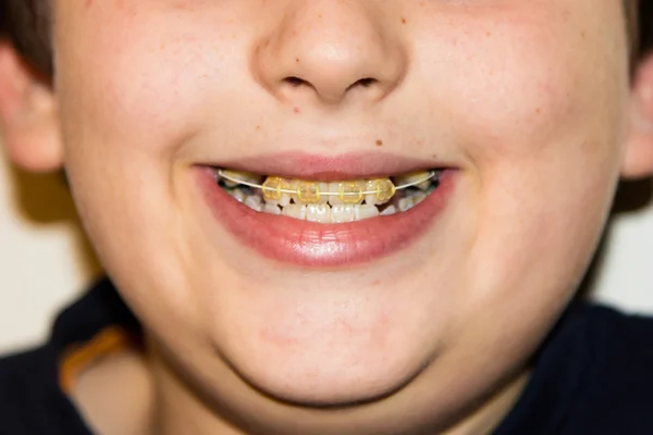 Frenos y dientes blancos del niño sonriente — Foto de Stock