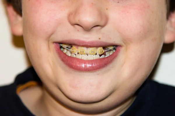 Hängslen och vita tänder leende pojke — Stockfoto