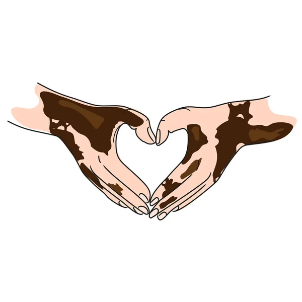 People Skin Problems Vitiligo Two Hands Making Heart Shape Gesture — Vetor de Stock