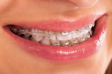 genç kadının Smile beyaz dişler diş teli ile gösterilen ayrıntı