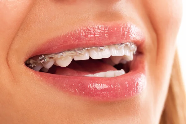 Prótesis dental fija —  Fotos de Stock
