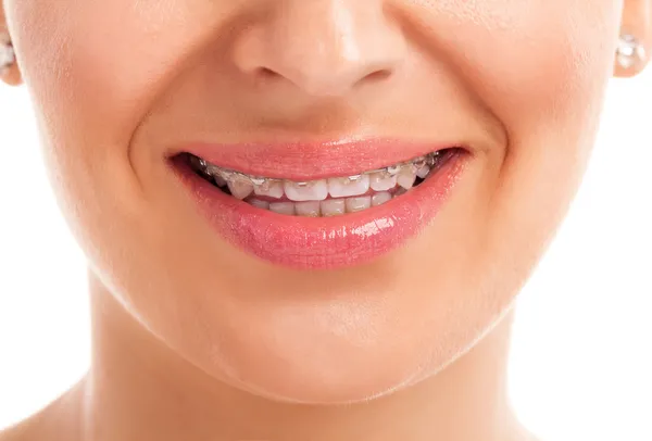 Mujeres cara con dentadura postiza — Foto de Stock