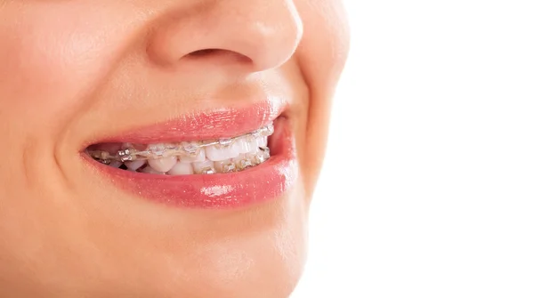 Teeth whitening — Stock Photo, Image