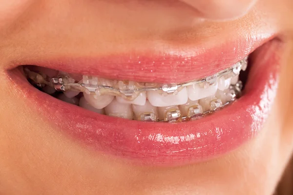 Detail of young womans smile showing white teeth with braces Stock Image