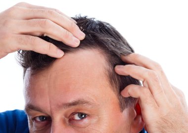 androjenik alopesi