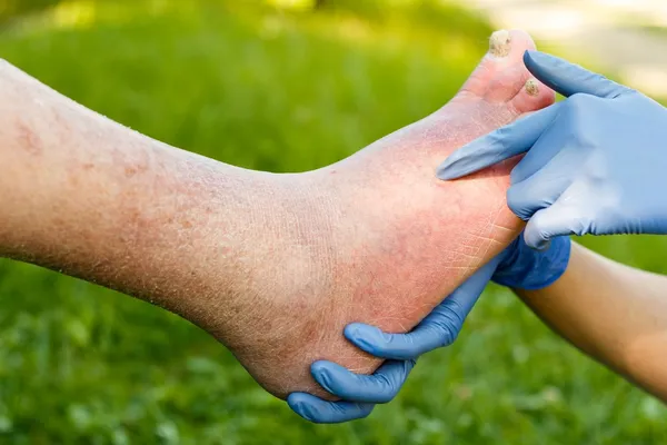 Arteriosclerotic Old Foot — Stock Photo, Image