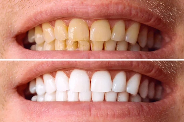 Teeth before and after whitening. Over white background. Dental clinic patient. Image symbolizes oral care dentistry, stomatology. — Stock Photo, Image
