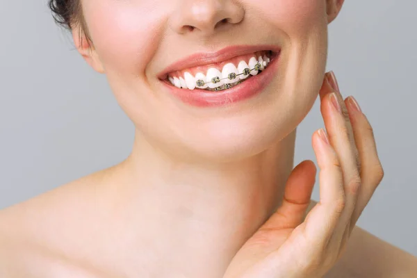 구강 요법 치료. 적절 한 치료를 받으세요 건강 한 미소를 지으 세요. 세라믹 과 금속으로 된 괄호를 치아에 덮는다. 교정기를 든 아름다운 여성의 웃음. — 스톡 사진