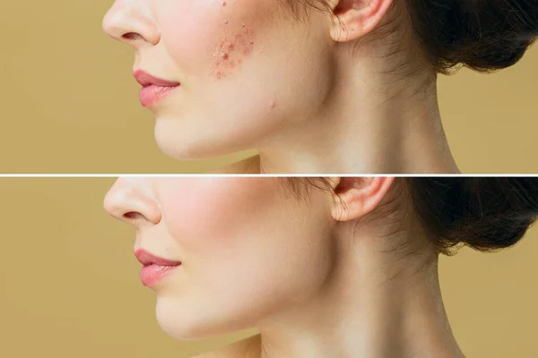 Jeune femme avant et après le traitement de l'acné. Concept de soins de la peau. — Photo