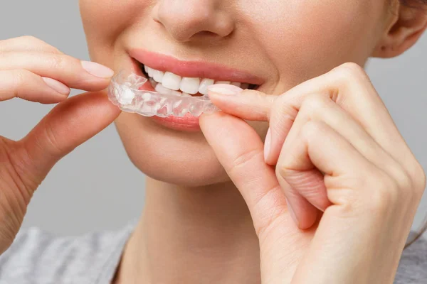Chránič úst na bělení zubů. Mladá žena provádí domácí bělení zubů. — Stock fotografie