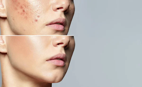 Young woman before and after acne treatment. Skin care concept.