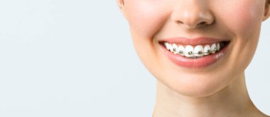 Ortodontik tedavi. Diş bakımı konsepti. Sağlıklı gülümseme, yakından. Kapalı seramik ve dişlerde metal parantez. Diş telleriyle güzel bir kadın gülüşü.