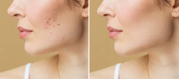 Mulher jovem antes e depois do tratamento da acne. Conceito de cuidados da pele. — Fotografia de Stock