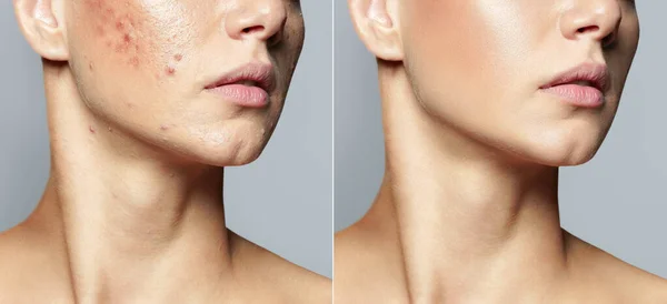 Teenage κορίτσι πριν και μετά τη θεραπεία της ακμής έννοια φροντίδας του δέρματος. Ακμή θεραπεία σε κλινική κοσμετολογίας — Φωτογραφία Αρχείου