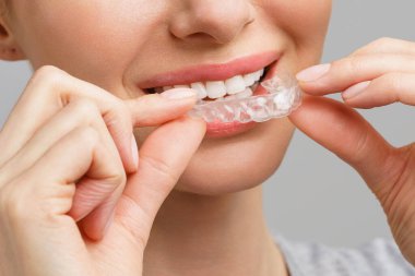 Genç bir kadın diş beyazlatma prosedürü uyguluyor. Jöleli beyazlatma tepsisi