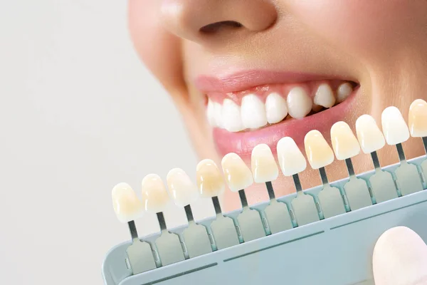 Una joven sonriente. Blanqueamiento dental cosmetológico en una clínica dental. selección del tono del diente del implante — Foto de Stock