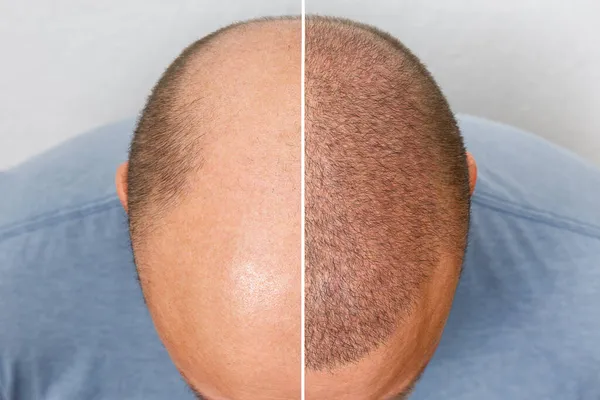 A cabeça de um homem careca antes e depois da cirurgia de transplante de cabelo. Um homem a perder o cabelo tornou-se desgrenhado. Um cartaz publicitário para uma clínica de transplante de cabelo. Tratamento da calvície. — Fotografia de Stock