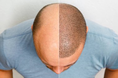 The head of a balding man before and after hair transplant surgery. A man losing his hair has become shaggy. An advertising poster for a hair transplant clinic. Treatment of baldness. clipart
