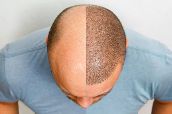 Het hoofd van een kalende man voor en na een haartransplantatie. Een man die z 'n haar verliest, is chagrijnig geworden. Een reclame poster voor een haartransplantatie kliniek. Behandeling van kaalheid. — Stockfoto