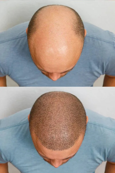 The head of a balding man before and after hair transplant surgery. A man losing his hair has become shaggy. An advertising poster for a hair transplant clinic. Treatment of baldness. — Stock Photo, Image
