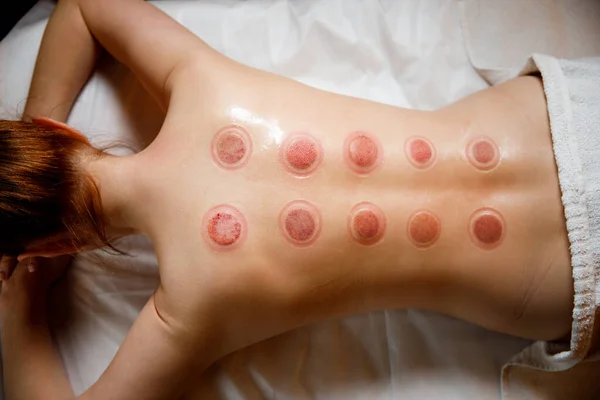 Mladá žena odpočívá v masážním salónu. Vakuové poháry lékařské cupping terapie na ženy zpět, zblízka, čínské medicíny. — Stock fotografie