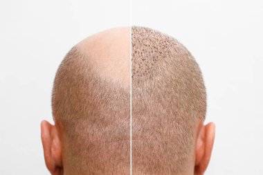 Saç nakli ameliyatından önce ve sonra kelleşen bir adamın başı. Saçları dökülen bir adam kabarık olmuş. Saç nakli kliniğinin reklam posteri. Kelliğin tedavisi.