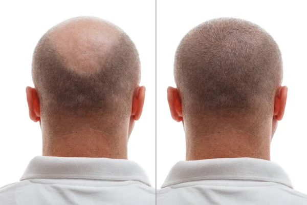 Το κεφάλι ενός φαλακρού άντρα πριν και μετά την εγχείρηση μεταμόσχευσης μαλλιών. Ένας άντρας που χάνει τα μαλλιά του έχει γίνει μαλλιαρός. Διαφημιστική αφίσα για κλινική μεταμόσχευσης μαλλιών. Θεραπεία της φαλάκρας. — Φωτογραφία Αρχείου