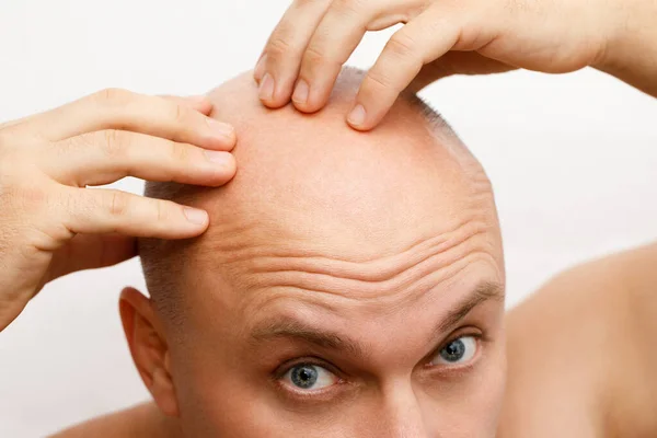 Het hoofd van een kalende man. Een kale man was overstuur door het haarverlies. Behandeling van kaalheid. — Stockfoto