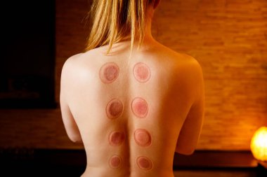 Genç bir kadın masaj salonunda dinleniyor. Kadınlara uygulanan elektrikli süpürge fincanları, Çin tıbbı..