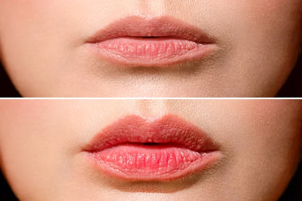 Resultado antes y después de dar forma a los labios. Una mujer hace corrección de forma labial en una clínica de cosmetología. Inyecciones de labios, aumento de labios. — Foto de Stock