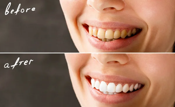 Woman teeth before and after whitening. Over white background. Dental clinic patient. Image symbolizes oral care dentistry, stomatology. — Stock Photo, Image