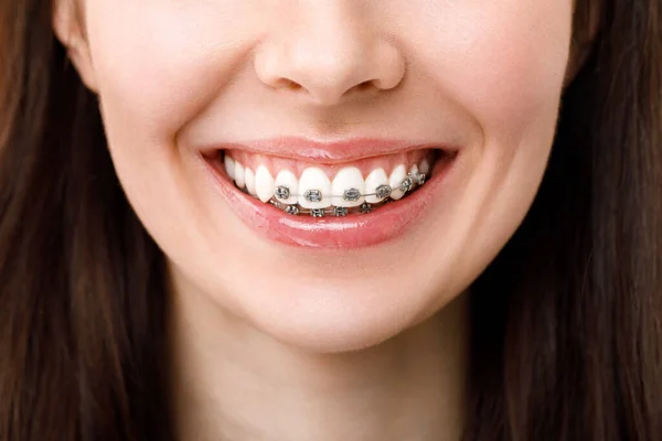 Leczenie ortodontyczne. Koncepcja opieki dentystycznej. Piękna kobieta Zdrowy uśmiech blisko. Zbliżenie ceramiczne i metalowe wsporniki na zębach. Piękny uśmiech kobiety z aparatem na zęby — Zdjęcie stockowe