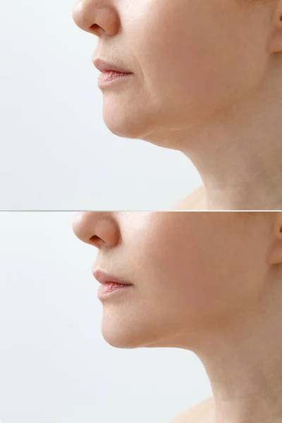 A close portrait of an aged woman before and after facial rejuvenation procedure. Correction of the chin shape liposuction of the neck. The result of the procedure in the clinic of aesthetic medicine. — Stock Photo, Image