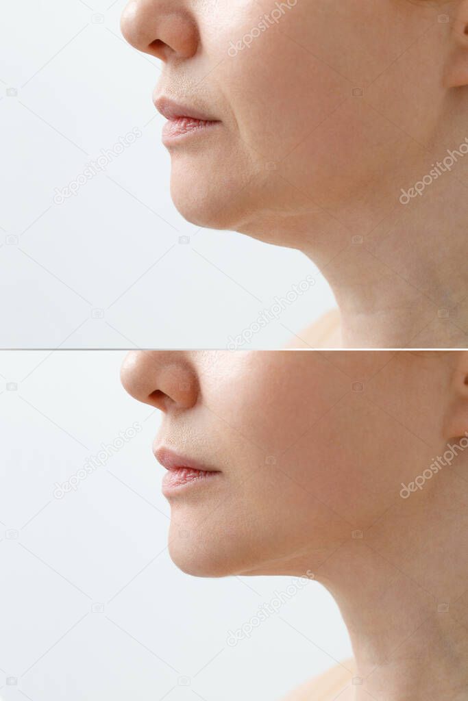 A close portrait of an aged woman before and after facial rejuvenation procedure. Correction of the chin shape liposuction of the neck. The result of the procedure in the clinic of aesthetic medicine.