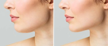 Yüz yenileme ameliyatından önce ve sonra yaşlı bir kadının portresi. Çenenin şeklindeki boynun liposakşının düzeltilmesi. Estetik tıp kliniğindeki prosedürün sonucu.