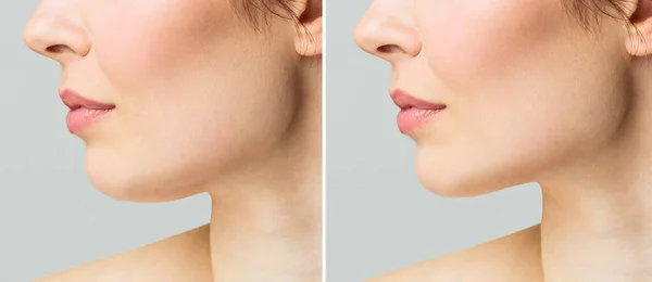 A close portrait of an aged woman before and after facial rejuvenation procedure. Correction of the chin shape liposuction of the neck. The result of the procedure in the clinic of aesthetic medicine. — Stock Photo, Image