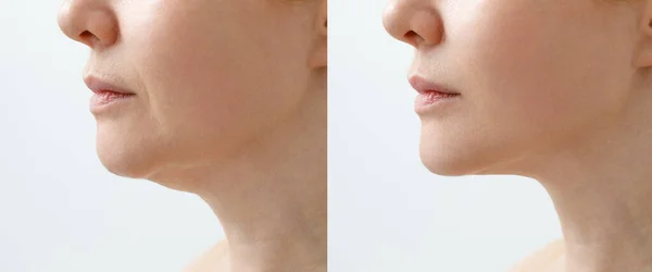 Portrait rapproché d'une femme âgée avant et après la procédure de rajeunissement du visage. Correction de la forme du menton liposuccion du cou. Le résultat de l'intervention en clinique de médecine esthétique. — Photo