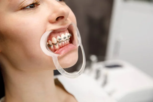 Mladá žena s kovovými rovnátky je vyšetřována ortodontistou. Oprava kousnutí zubů na zubní klinice. Koncept zdravých zubů. — Stock fotografie