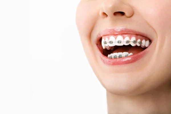 Orthodontische behandeling. Tandheelkundige zorg concept. Mooie vrouw gezonde glimlach close-up. Closeup keramische en metalen beugels op tanden. Mooie vrouwelijke glimlach met beugels Stockfoto