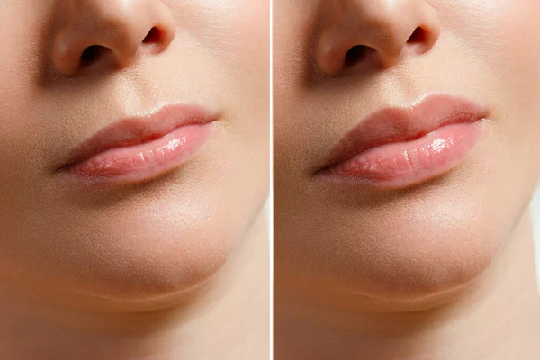 Uma mulher faz correção de forma labial em uma clínica de cosmetologia. Injeções dos lábios, aumento dos lábios. — Fotografia de Stock