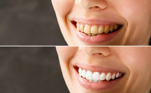 Dientes de mujer antes y después del blanqueamiento. Paciente de la clínica dental. La imagen simboliza el cuidado bucal odontología, estomatología. —  Fotos de Stock