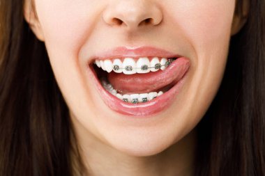 Ortodontik tedavi. Diş bakımı konsepti. Güzel Sağlıklı Kadın Gülümse, yakından. Kapanış Seramik ve Metal Parantez Dişler. Güzel Dişi Diş telleriyle Gülümse