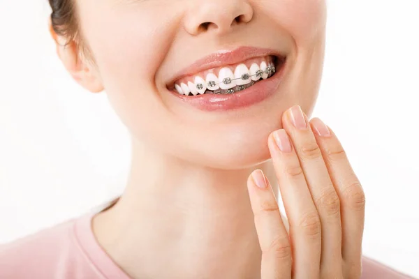Úsměv s rovnátka ortodontické zacházení. Pojetí zubní péče. Krásná žena zdravý úsměv zblízka. Detailní keramické a kovové držáky na zuby. Krásná žena — Stock fotografie