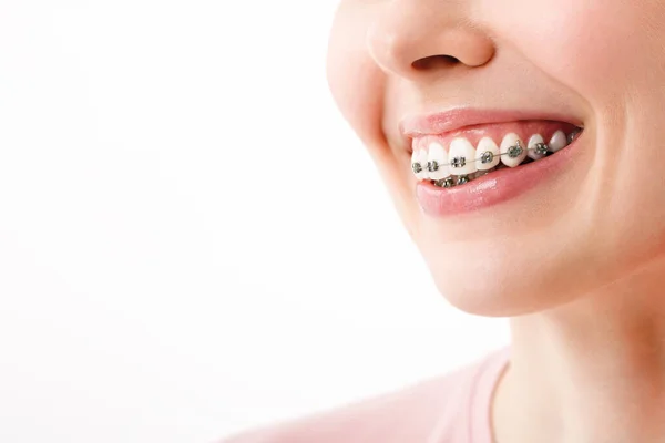 Leczenie ortodontyczne. Koncepcja opieki dentystycznej. Piękna kobieta Zdrowy uśmiech blisko. Zbliżenie ceramiczne i metalowe wsporniki na zębach. Piękny uśmiech kobiety z aparatem na zęby — Zdjęcie stockowe