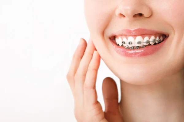 Le med tandställning Ortodontic Treatment. Tandvårdskoncept. Vacker kvinna Friska leende närbild. Närbild Keramik och metall fästen på tänder. Vacker kvinna — Stockfoto