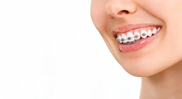 Úsměv s rovnátka ortodontické zacházení. Pojetí zubní péče. Krásná žena zdravý úsměv zblízka. Detailní keramické a kovové držáky na zuby. Krásná žena — Stock fotografie