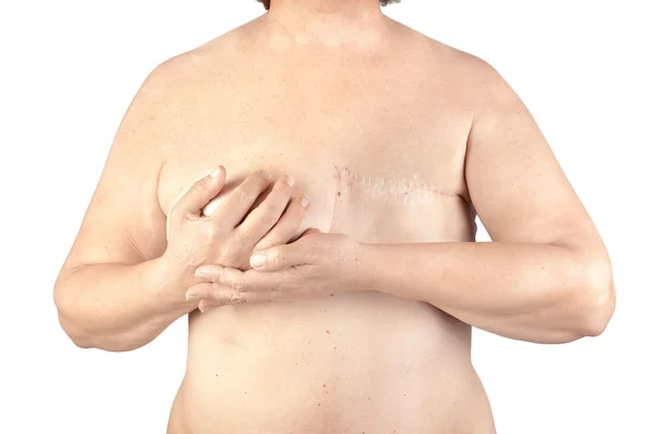 Rak piersi — Zdjęcie stockowe
